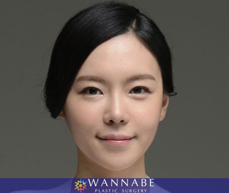 Two Jaw Surgery