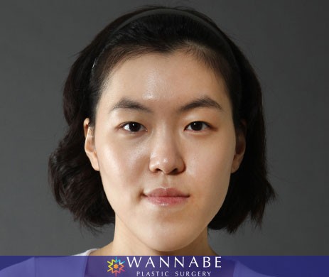 Two Jaw Surgery
