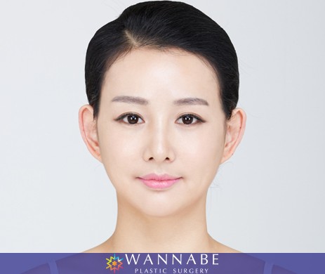 Cheekbone reduction +Thread lift 4