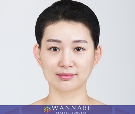 Cheekbone reduction +Thread lift 4