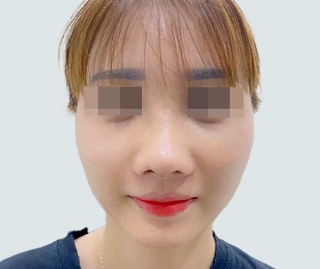 Mũi Cấu Trúc Sụn Sườn – Cà Gồ – Cắt Cánh