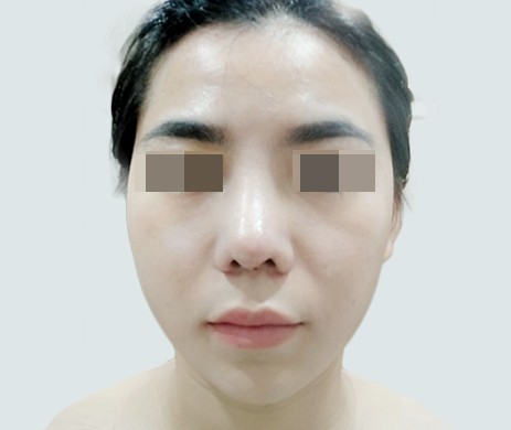 Mũi Cấu Trúc Sửa Lại – Cắt Xương