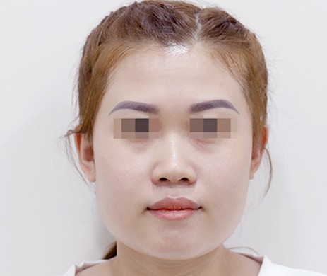 Mũi Lót Sụn – Cắt Xương