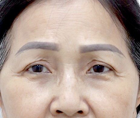 Treo Cung Mày – Bs Nguyễn Khanh