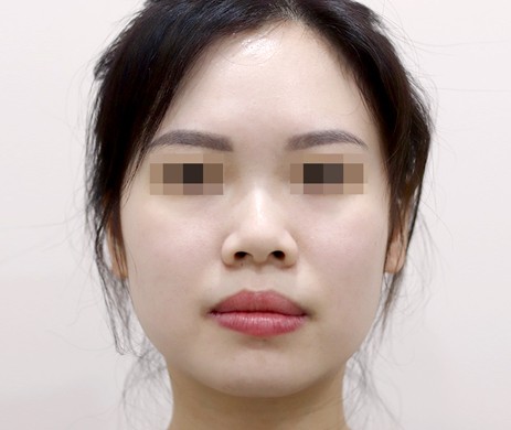 Độn Cằm