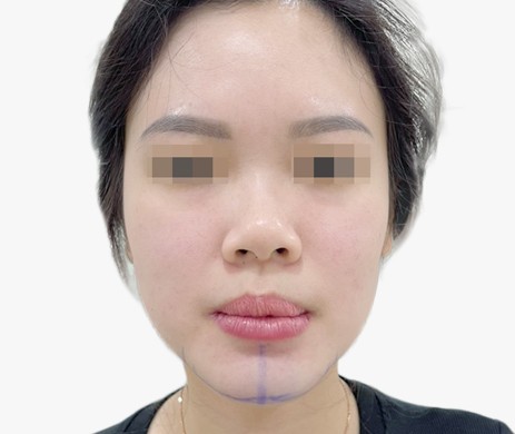 Độn Cằm