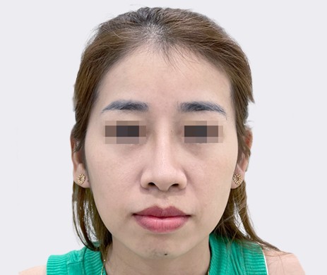 Độn Cằm