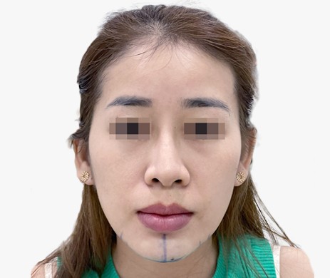 Độn Cằm