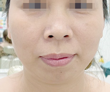 Độn Cằm
