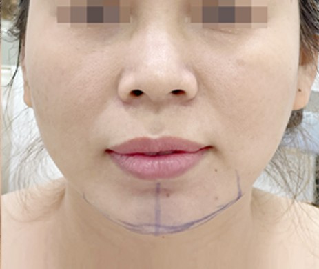 Độn Cằm
