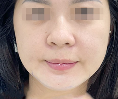 Độn Cằm