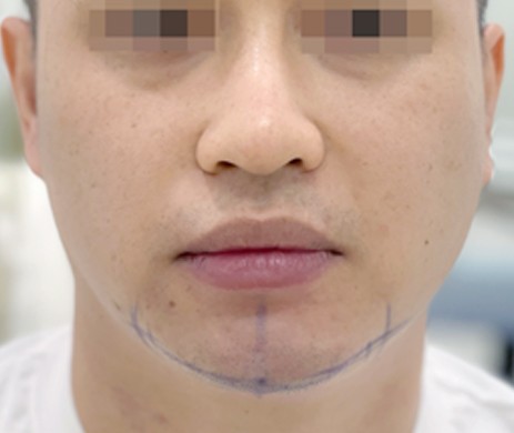 Độn Cằm Nam