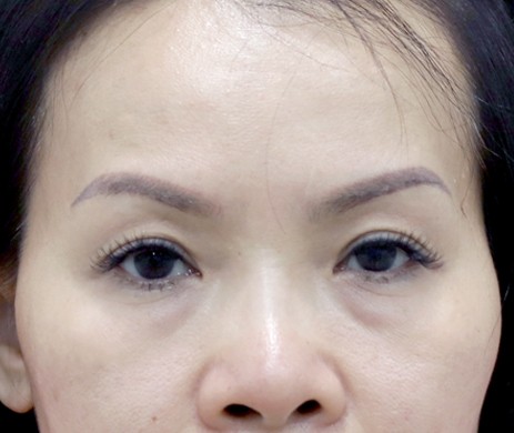 Cắt Mí Dưới