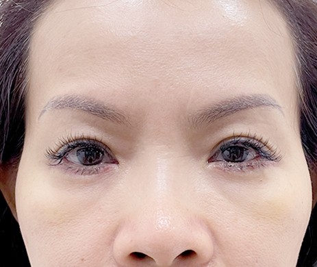 Cắt Mí Dưới