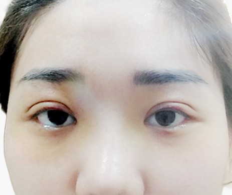 Nhấn Mí