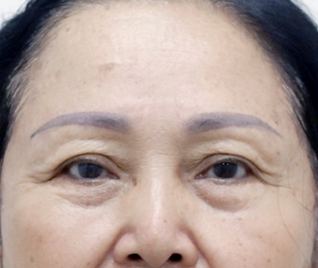 Treo Cung Mày