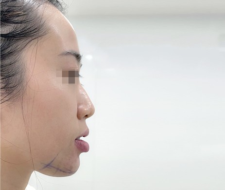 Độn cằm