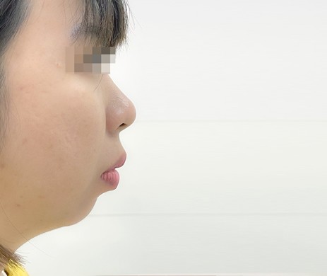 Độn cằm