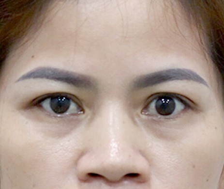 Treo cung mày