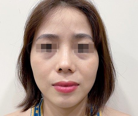 Mũi cấu trúc sụn sườn sửa lại