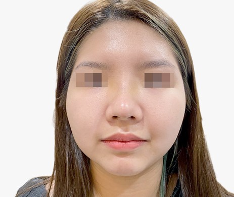 Mũi lót sụn – Cà gồ