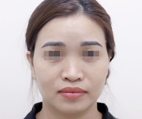 Mũi lót sụn
