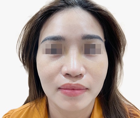 Mũi lót sụn