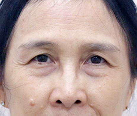 Treo cung mày