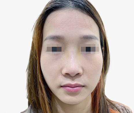 Mũi lót sụn – Thu chóp