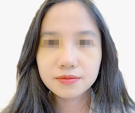 Mũi lót sụn – Thu chóp – Cà gồ