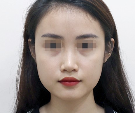 Mũi lót sụn