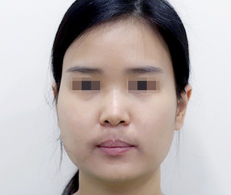 Mũi lót sụn