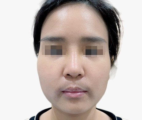 Mũi lót sụn