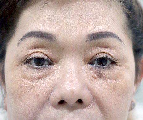 Cắt mí dưới