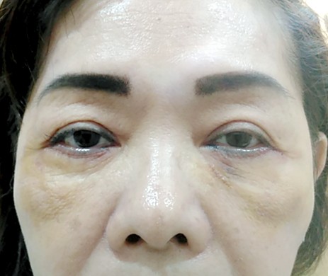 Cắt mí dưới
