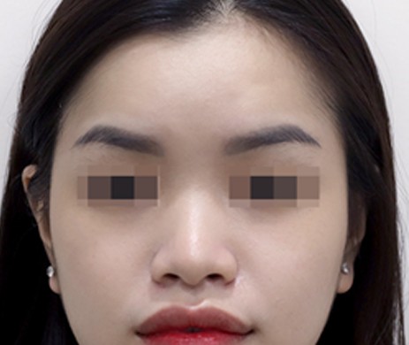 Mũi lót sụn