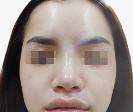 Mũi lót sụn