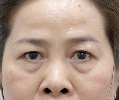 Cắt mí dưới