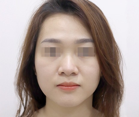 Mũi lót sụn – Cắt cánh
