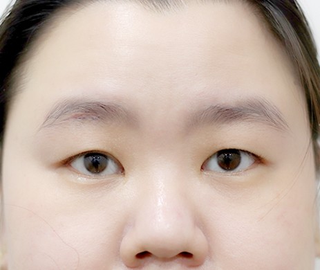 Cắt mí trên
