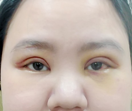 Cắt mí trên