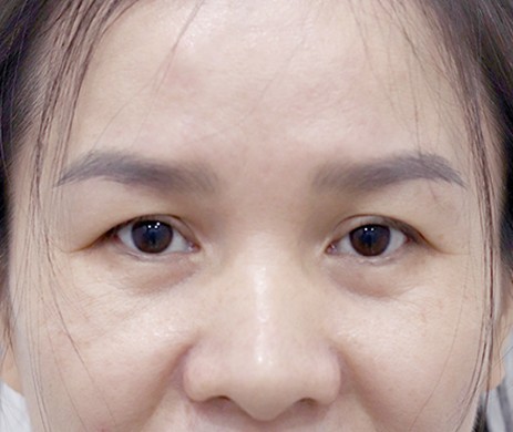 Cắt mí trên