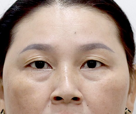 Nhấn mí