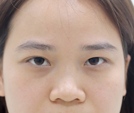 Nhấn mí