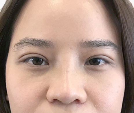 Nhấn mí
