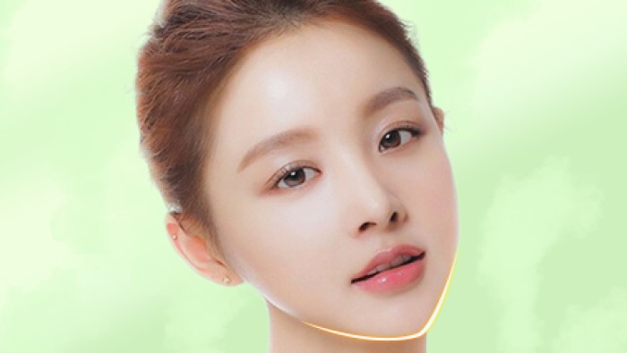 Phẫu thuật độn cằm V-line
