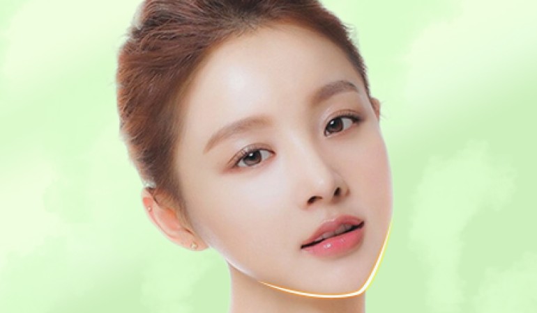 Phẫu thuật độn cằm V-line